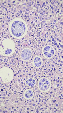 Histopathology of cirrhosis in human liver, light micrograph, photo under microscope