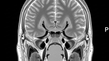 X-ray of the brain. The brain is highlighted in black and white.