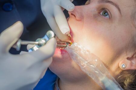 Great concept of dental procedure, young blond Brazilian woman in dental chair suffering dental procedure by dentist.の写真素材