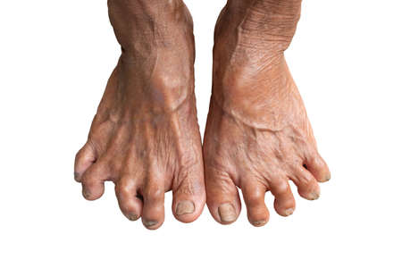 Closeup Foot Seniors. dirty feet on mortar. toenail fungus. Fungus Infection on Nails of Man's Foot.の写真素材