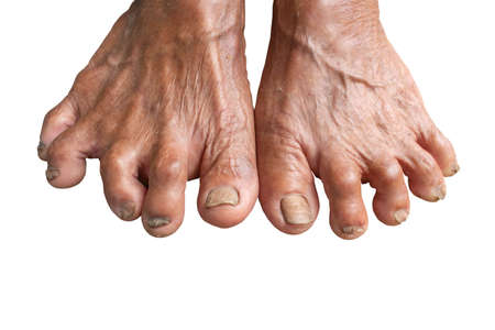 Closeup Foot Seniors. dirty feet on mortar. toenail fungus. Fungus Infection on Nails of Man's Foot.  isolated on white backgroundの写真素材