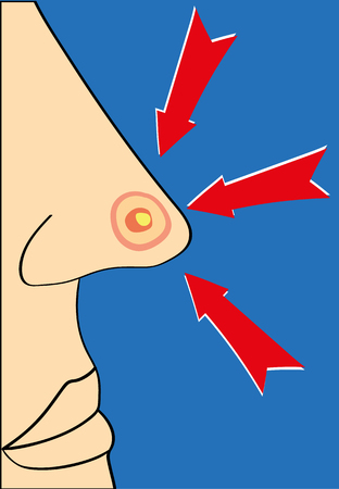 Close up of a nose with a large red spot or pimple with a white head and three red arrows pointing at itのイラスト素材
