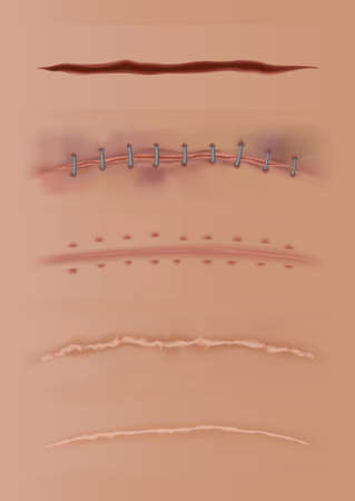 Set of healing wounds, skin scars, stitched gash and cuts. Realistic surgical sutures, stitched wounds at different healing stages isolated on human skin backgroundの素材 [FY310172247112]