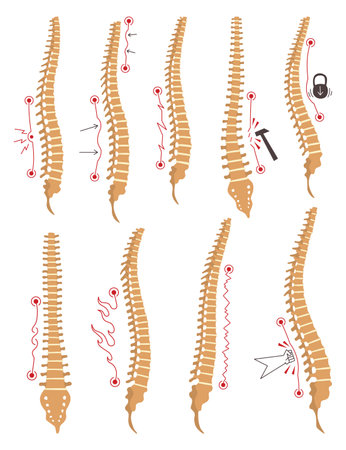 Spinal deformity types. Symbols of spine curvatures or unhealthy backbones. Human spine anatomy, curved spine. Diagram with marked sections. Body posture defectsのイラスト素材