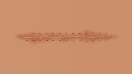 Healing wounds, skin scar, stitched gash and cut. Realistic surgical suture, stitched wounds. Healing stage on human skin background. Vector illustrationのイラスト素材