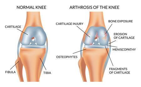 Knee arthrosis. Healthy knee and sore knee with damaged structure. Bone exposure damaged and healthy knee structure comparison. Medical poster with foot bones. Isolated vector illustrationのイラスト素材