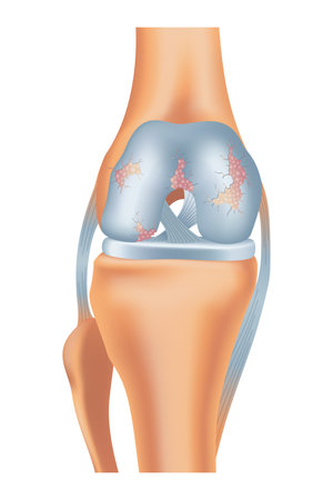 Knee arthrosis. Unhealthy knee structure. Bone exposure, damaged knee structure comparison. Medical poster with foot bones. Isolated vector illustrationのイラスト素材