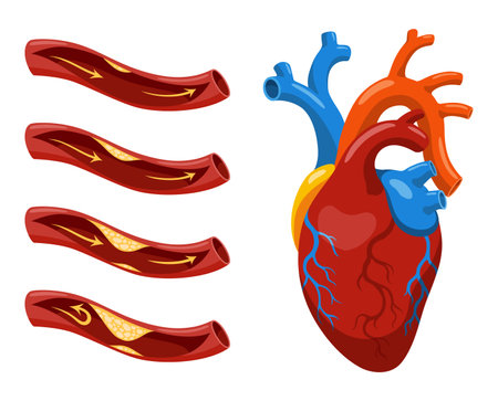 Atherosclerosis stages. Anatomy of heart attack. Arteriosclerotic vascular disease or ASVD. Atherosclerotic plaque in coronary artery. Vector illustration on white backgroundのイラスト素材