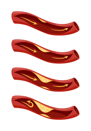 Atherosclerosis stage icon set. Anatomy of heart attack. Arteriosclerotic vascular disease or ASVD. Atherosclerotic plaque in coronary artery. Vector illustration on white backgroundのイラスト素材