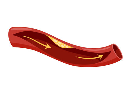 Atherosclerosis stage. Anatomy of heart attack. Arteriosclerotic vascular disease or ASVD. Atherosclerotic plaque in coronary artery. Vector illustration on white backgroundのイラスト素材