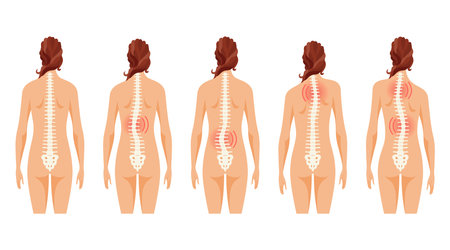 This article covers the different types of scoliosis affecting individuals of all agesのイラスト素材