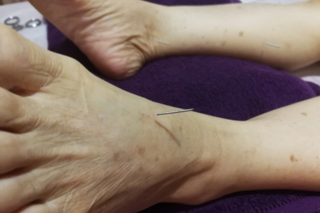 Acupuncture Treatment - Chinese medicine, Young woman getting acupuncture treatment in therapy roomの写真素材