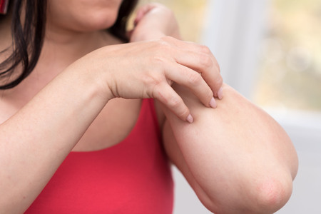 Young woman having itchy and scratching her arm