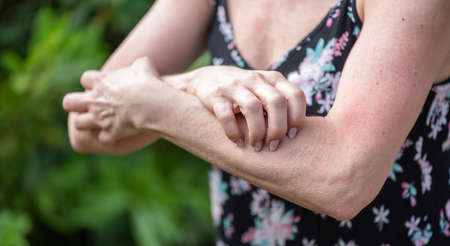 Woman having itchy and scratching her arm