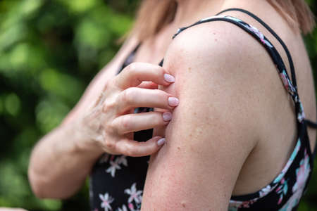 Woman having itchy and scratching her arm