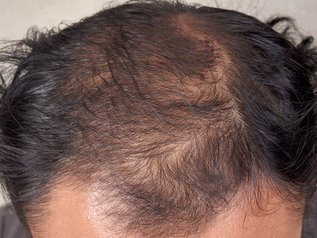 closeup of hair lose or bald head manの写真素材