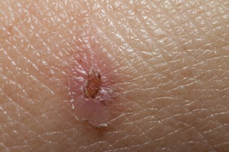 Soft Wounds on the skin