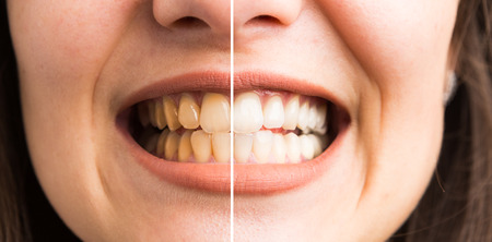 Before and after teeth whitening concept with woman denture yellow and whiteの写真素材
