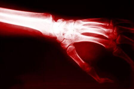 classic red x-ray image of handの写真素材