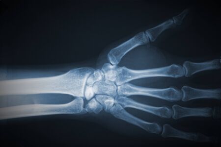 detail of hand xray filmの写真素材