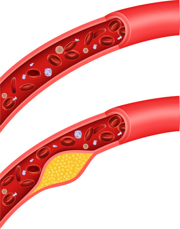 Vector illustration of cholesterol blocking arteryのイラスト素材