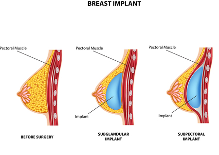 Vector illustration of Plastic surgery of breast implantのイラスト素材