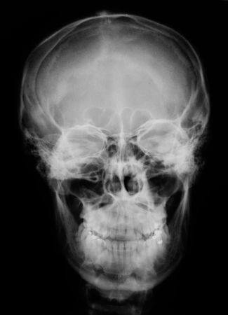 X-ray of skull