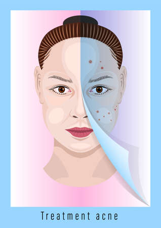 Woman face before and after treatment acneのイラスト素材