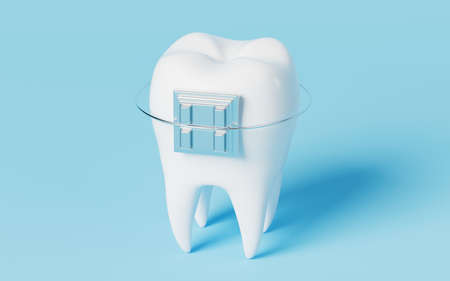 Tooth brace in the blue background, 3d rendering. Computer digital drawing.の写真素材