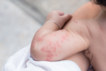 Close up image of baby skin texture suffering severe urticaria, nettle rash.の写真素材