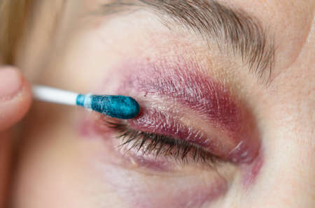 Close-up photograph of the processing of a surgical suture on the upper eyelid.の写真素材