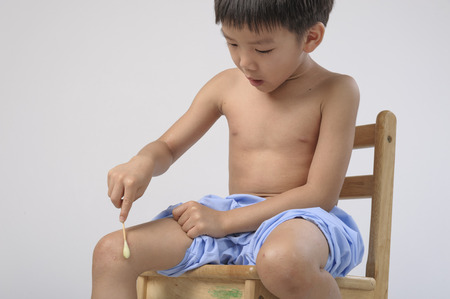 Uricaria occur in kid leg and treating by wax on cottonの写真素材