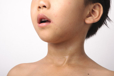 the herpes on young boy mouth feel painの写真素材