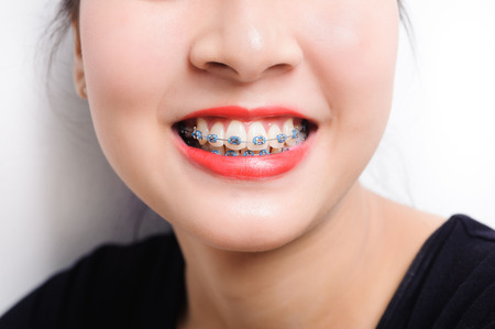 Orthodontic dental in beautiful young asian girl