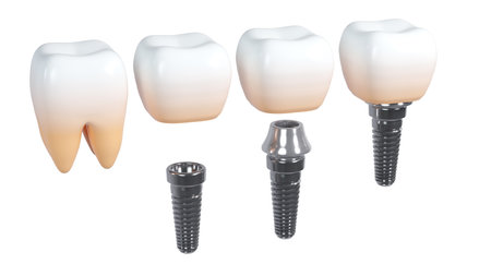 3D rendering of tooth implants with ceramic crowns on a white background, Modern dental surgery conceptの写真素材