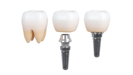 3D rendering of tooth implants with ceramic crowns on a white background, Modern dental surgery conceptの写真素材