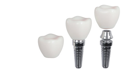 3D rendering of tooth implants with ceramic crowns on a white background, Modern dental surgery conceptの写真素材