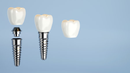 3D rendering of dental implant structure, medical teeth implant, design of dentistry, implant screw, healthcare, dentist and orthodontist treatmentの写真素材