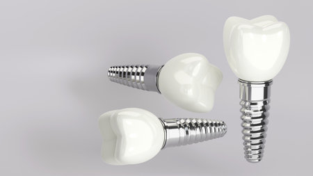 3D rendering of dental implant structure, medical teeth implant, design of dentistry, implant screw, healthcare, dentist and orthodontist treatment, Dental implants surgery conceptの写真素材