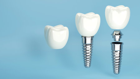 3D rendering of dental implant structure, medical teeth implant, design of dentistry, implant screw, healthcare, dentist and orthodontist treatment, Dental implants surgery conceptの写真素材