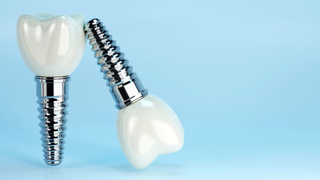 3D rendering of dental implant structure, medical teeth implant, design of dentistry, implant screw, healthcare, dentist and orthodontist treatment, Dental implants surgery conceptの写真素材