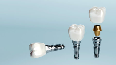 3D rendering of dental implant structure, medical teeth implant, design of dentistry, implant screw, healthcare, dentist and orthodontist treatmentの写真素材