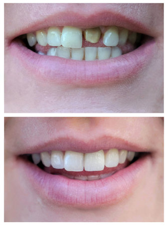 Smiling woman with a bad tooth before and after treatment. Close-up. Veneers, whitening, building....