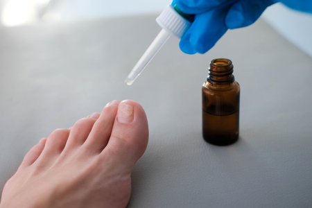 The doctor drips medicine from a pipette onto a sore finger. Close-up of a foot with nail fungus....