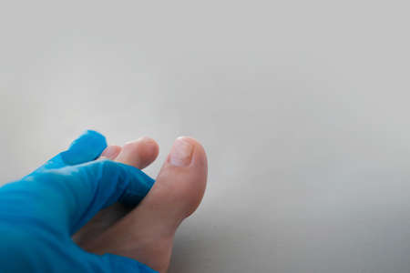 A close-up of a foot with a fungus on the nails is examined by a doctor in gloves. Onycholysis: detachment of the nail from the nail bed.の写真素材