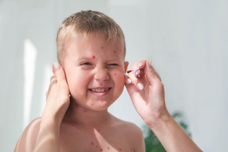 Treatment of ulcers from chickenpox, chickenpox with a healing cream on the skin of a child. Mom treats the child's face with red medicine.の写真素材