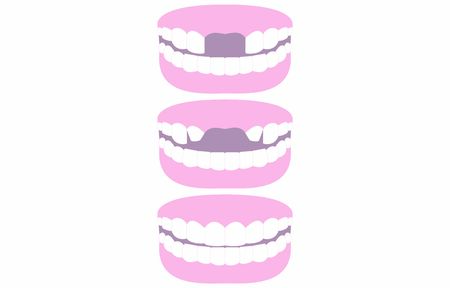 Illustration set of teeth bridging the missing front teethのイラスト素材