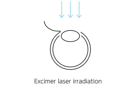 Medical illustration of LASIK and refractive surgeryのイラスト素材