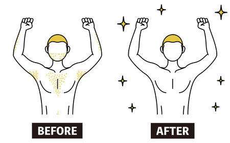 Image of medical hair removal, before-and-after of a man suffering from thick body hair being removed and becoming smooth.のイラスト素材