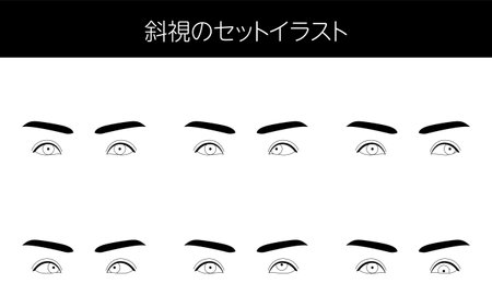 Medical illustration, Illustrative set eye diseases and strabismus - Translation: Clip art of strabismus setのイラスト素材